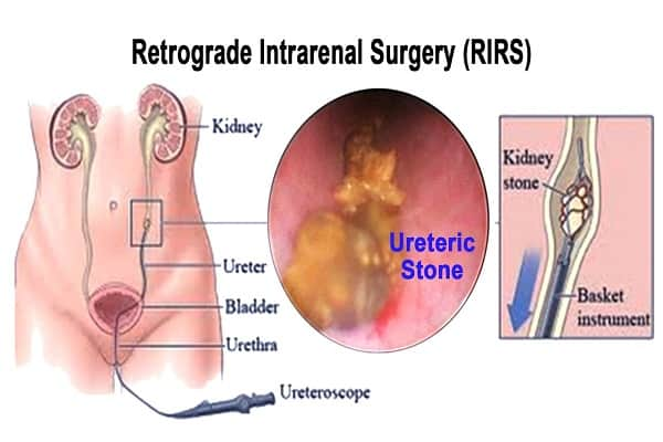 Retrograde Intrarenal Surgery(RIRS)