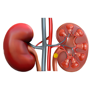 stones in kidney